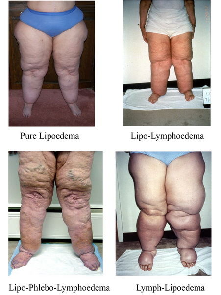 Kristin Osborn's Newcastle Lymphoedema & Lipoedema Clinic